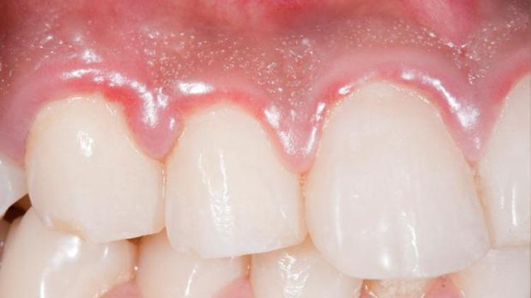 Diş iltihabına ne iyi gelir ve evde nasıl geçer Diş iltihabı neden olur, belirtileri nelerdir Diş iltihabına bitkisel çözüm