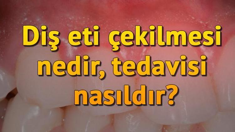 Diş eti çekilmesi nedir, tedavisi nasıldır