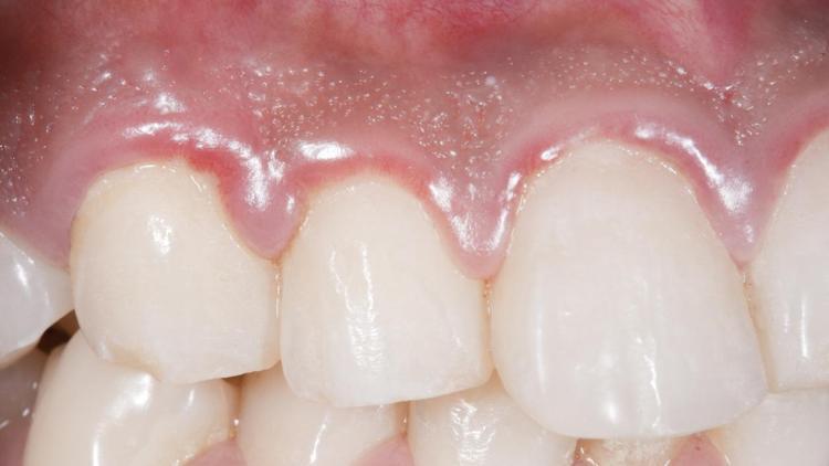 Rüyada diş görmek ne anlama gelir? Rüyada çürük diş görmenin tabiri