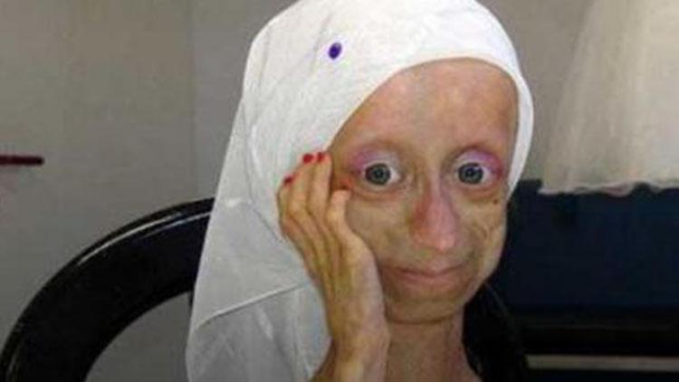 Progeria ne demek Erken yaşlanma hastalığı nedir
