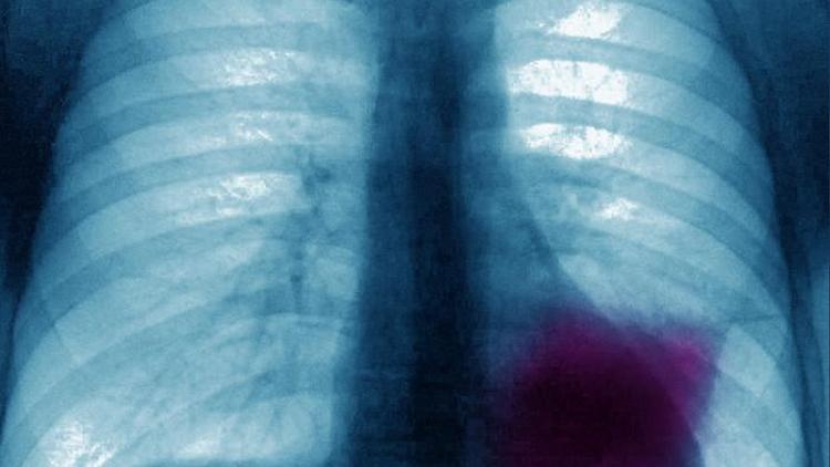 Akciğer kanseri nasıl belirti verir?