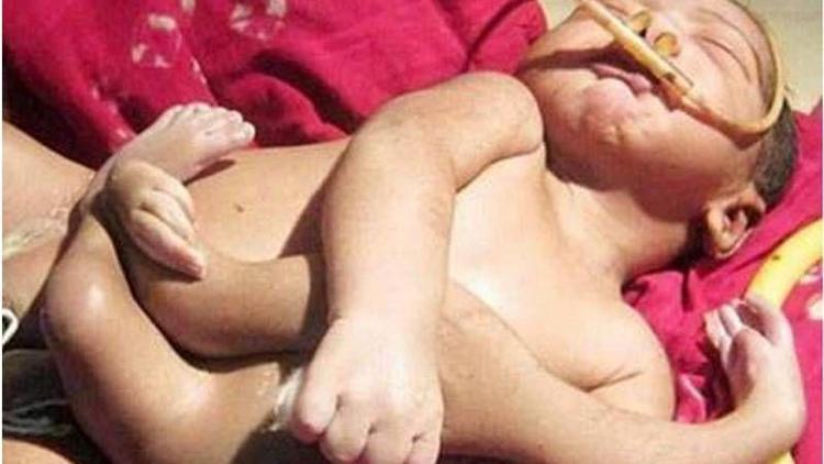 Hindistan’da 4 kollu ve 4 bacaklı bebek doğdu