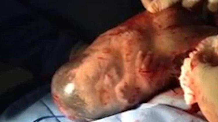 Amniyotik kesede doğan bebeğin inanılmaz videosu