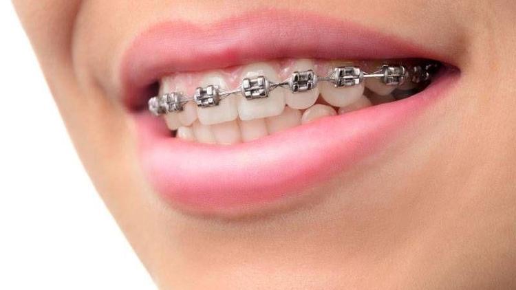 Hızlı diş telleri nedir?