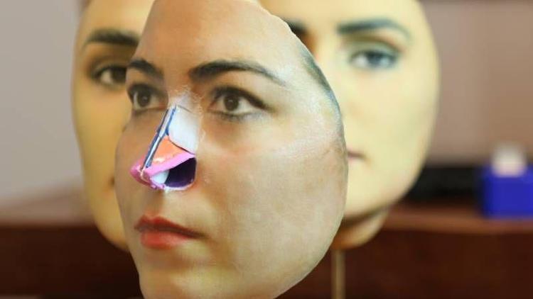 3D mask yöntemi ile burun estetiği