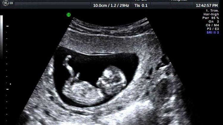 Ultrasonda bebeklerini görünce şok oldular!