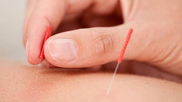 Akupunktur, tüp bebekte işe yarıyor mu?