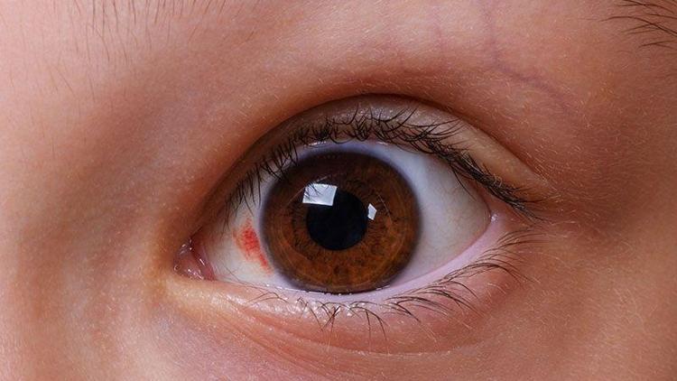Glokom (göz tansiyonu) nedir? Belirtileri ve tedavisi