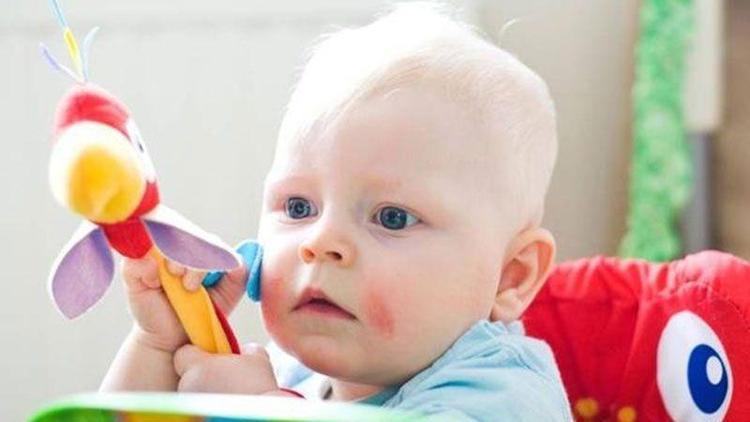 Bebeklerde atopik dermatite karşı etkili öneriler