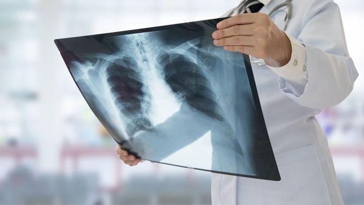 Akciğer kanserinin görülme sıklığı yaşla birlikte artıyor