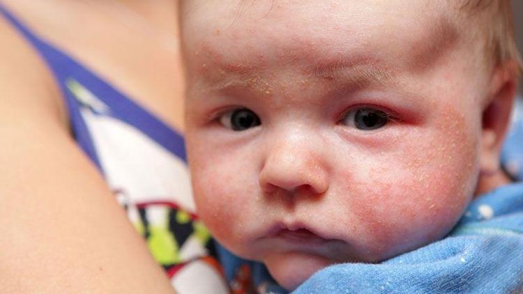 Besin alerjisine en çok çocuklar yakalanıyor