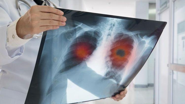 Kansere bağlı ölümlerin yüzde 80’i akciğer kanserinden kaynaklı