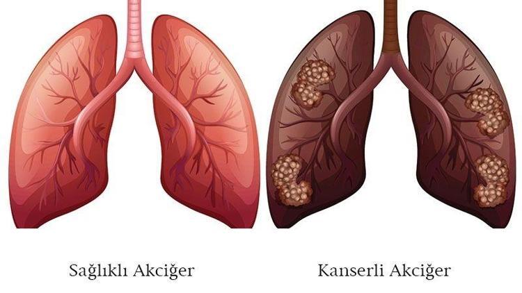 Akciğer kanseri evreleri yaşam süresi ve tedavisi