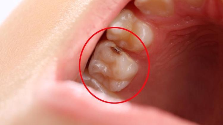 Çocuklarda diş çürüklerine dikkat! Mutlaka tedavi edilmeli