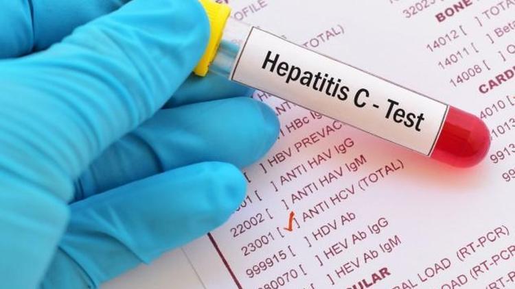 Hepatit C Nedir? Belirtileri, Teşhisi ve Tedavisi Nasıldır?