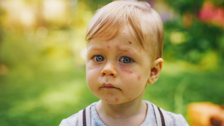 Çocuklarda görülen alerjinin temelinde ailesel yatkınlık yer alıyor