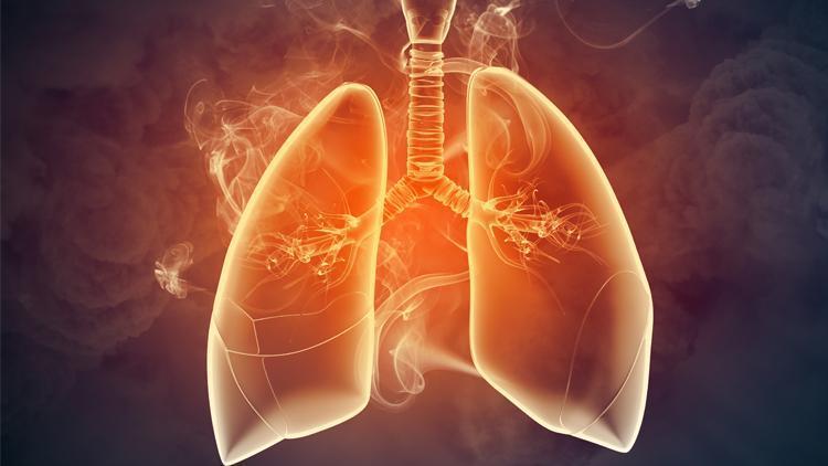 Pandemi döneminde akciğer kanseri vakaları arttı