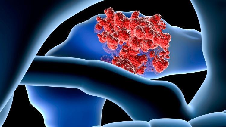 Pankreans Kanserinin Radyasyon Tedavisinde 5 Yeni Gelişme!