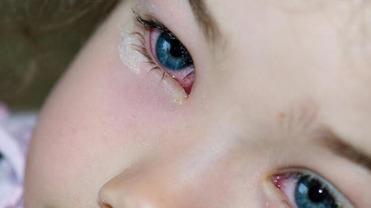 Çocuklarda göz çapaklanması neden olur? Önlemek için nelere dikkat edilmeli?
