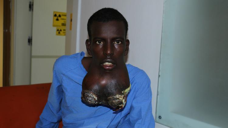 Tam 2 buçuk kilo Somalili genç tümörden kurtuldu