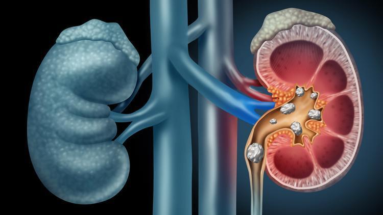 Böbrek taşı oluşumunu engellemek için öneriler