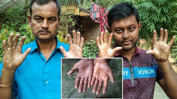 Bangladeşte parmak izi olmayan adam görenleri şaşırtıyor