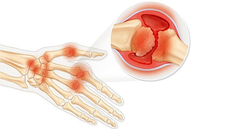 Romatizmal Rahatsızlıkların Tedavisini Ertelemeyin! Kalıcı Sorunlara Neden Olabilir