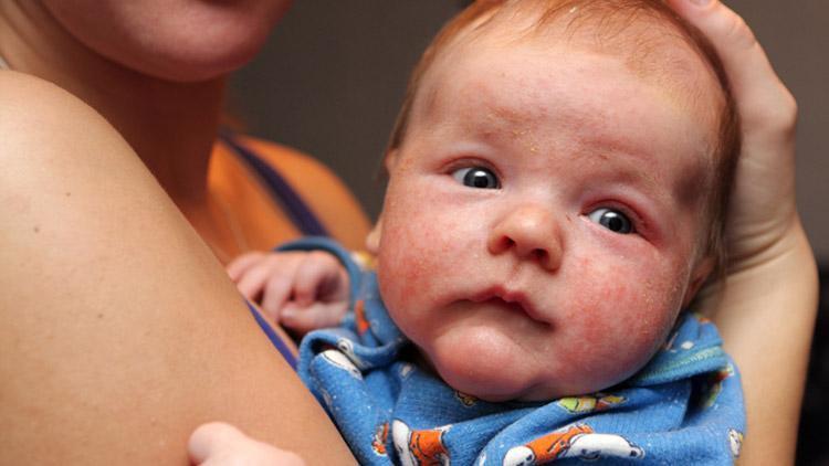 Bebeklerde yumurta alerjisi neden olur, nasıl tedavi edilir?