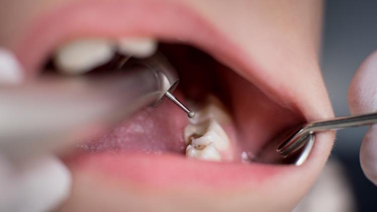 Çocuklarda meydana gelen diş travmalarında nelere dikkat edilmeli