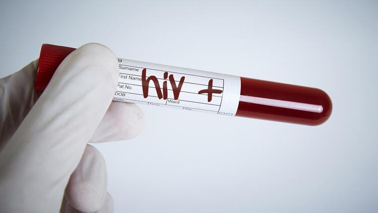HIV virüsü nedir ve nasıl bulaşır HIV hastalığı tedavisi ile ilgili merak edilenler