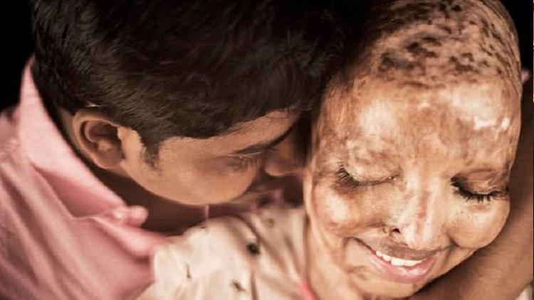 Hindistan’da asitli saldırıya uğrayan kadın gerçek aşkı 13 yıl sonra buldu