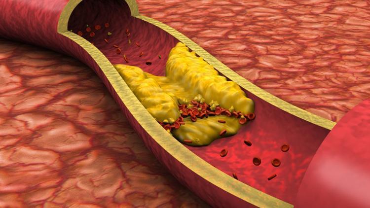 Kolesterol neden olur, belirtileri nelerdir? İşte kolesterolü düşüren besinler