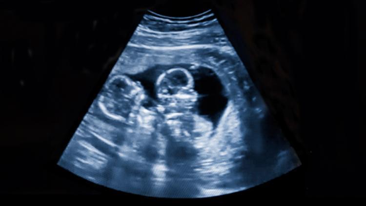 Rüyada İkiz Erkek Bebek Görmek Ne Anlama Gelir? Rüyada İkiz Bebek Doğurmak Ve Emzirmek Anlamı