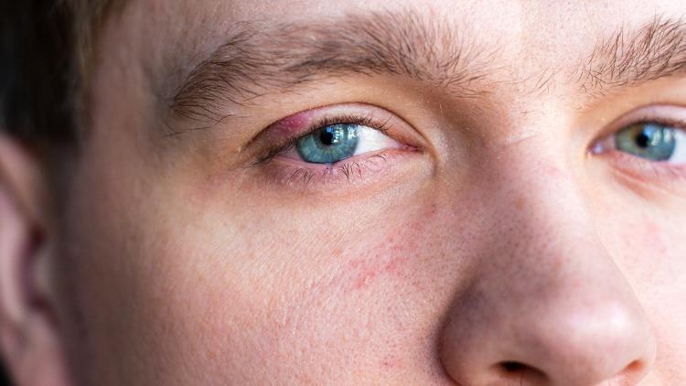 Göz kapakları neden şişer, nasıl geçer? Göz kapağı şişmesine iyi gelen bitkisel tedavi yöntemler