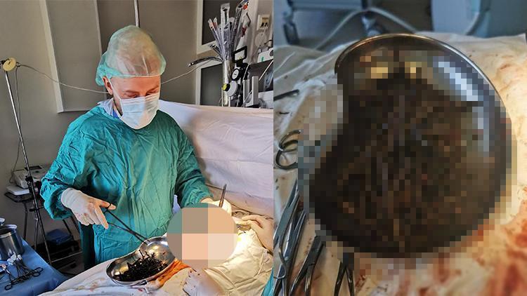 Doktorlar inanamadı: Midesinden bir kilo çivi ve vida çıktı