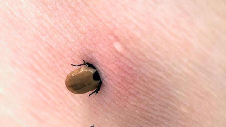 Lyme Hastalığı Nedir, Nasıl Bulaşır? Lyme Hastalığı Belirtileri ve Tedavisi