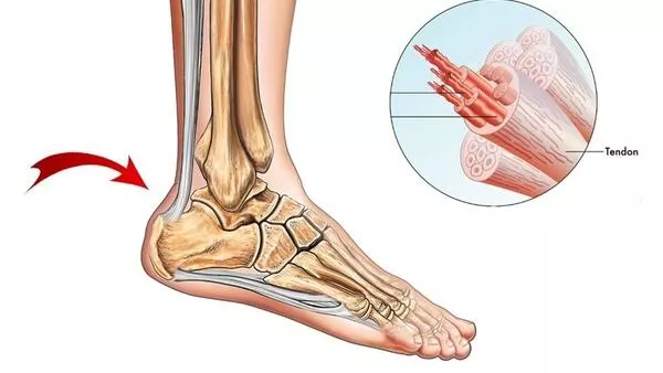 Aşil tendonu kopması nasıl olur Aşil tendonu nedir İşte merak edilenler