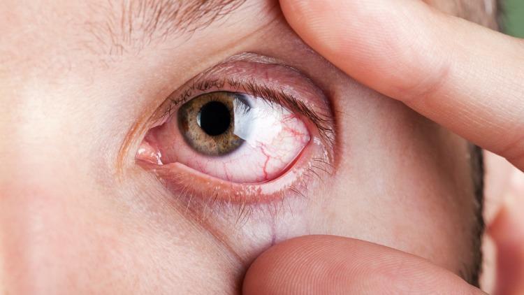Yaz aylarında göz enfeksiyonuna dikkat! Göz sağlığını korumak için yapılması gerekenler