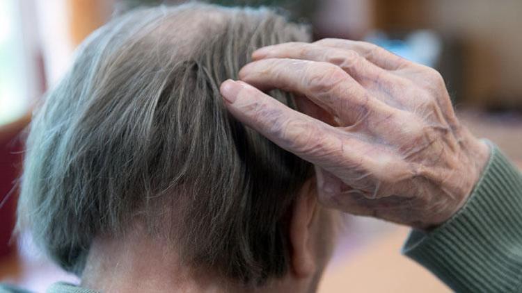 Alzheimer olan hasta sayısı artıyor