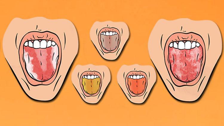 Dildeki renk değişimleri hangi hastalıkların habercisi Sağlıklı dil nasıl anlaşılır