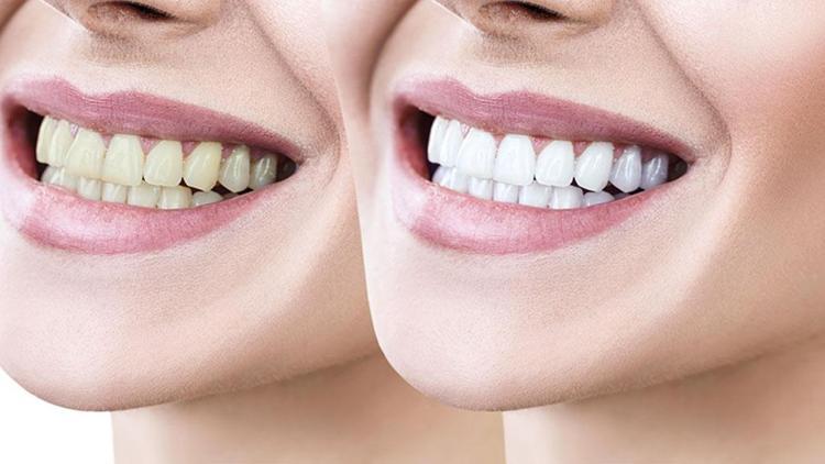 DOSYA | Diş beyazlatmak ne kadar güvenli