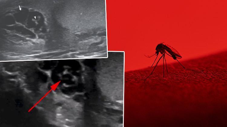 Her şey bir sivrisinek ısırığı ile başladı... Korkunç gerçeği ultrason çektirince öğrendi: Düzinelerce solucan vücudunda haftalarca yaşadı