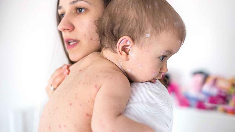 Bakan Koca’dan kızamık açıklaması: Artış var aşı takvimini aksatmayın