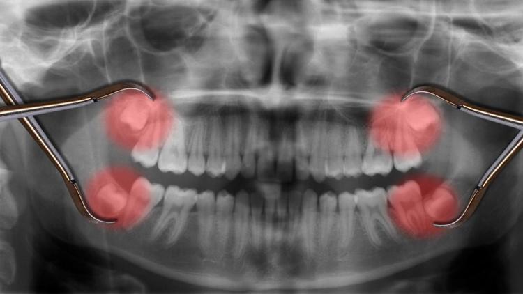 Diş hekimleri bunu tartışıyor: Yirmi yaş dişleri sorunlar başlamadan önce çektirilmeli mi | 8 SORU 8 YANIT