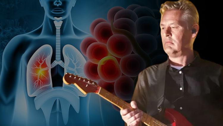 Ünlü gitarist akciğer kanserine yenik düştü! Dünyada ve Türkiye’de hızla yayılıyor... Tırnak şekilleri hastalığa dair işaret veriyor