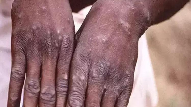 Afrika ülkesinde Maymun çiçeği alarmı: Acil durum ilan edildi