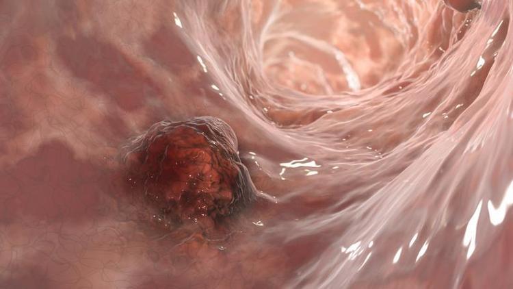Türkiye listede 15'inci sırada... Araştırma sonuçları şaşırttı: 1 kilogramlık artış yüzde 9 risk anlamına geliyor!