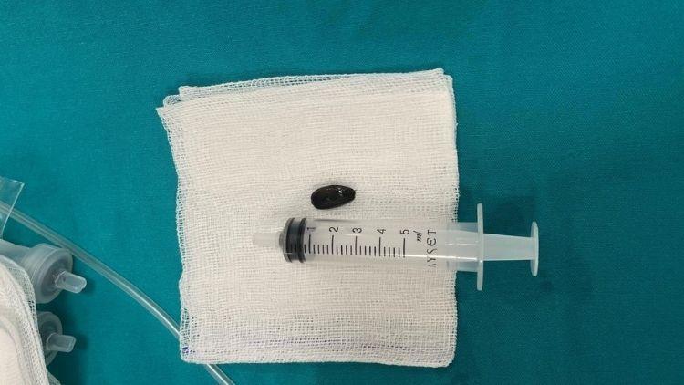 Akciğerine çekirdek kabuğu kaçtı 15 aylık bebek acil müdahaleyle kurtarıldı