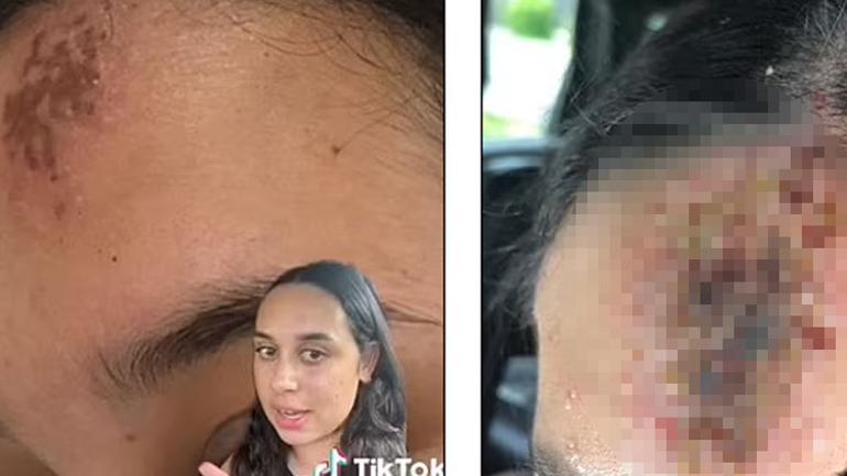 Alnındaki küçük bir yara yemek yiyemez hale getirdi, hastanelik oldu Bu virüse dikkat...