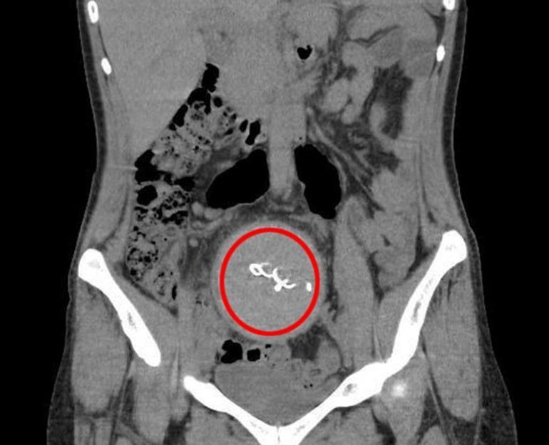 �zel hastanedeki do�umda skandal! Annenin v�cudunda unuttular, 2 y�l sonra fark edildi